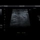 Epiploic appendagitis: US - Ultrasound